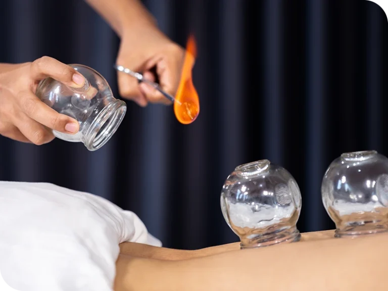 cupping